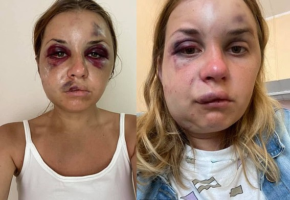 Ukrainian TV presenter suffers horrific injuries after being beaten by a stranger who tried to rape her